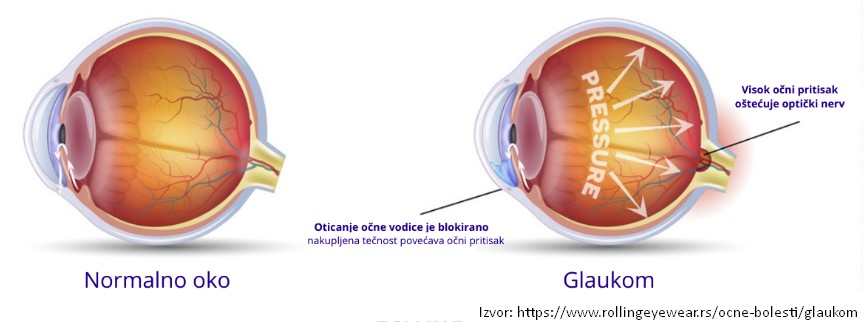 glaukom povisen ocni pritisak